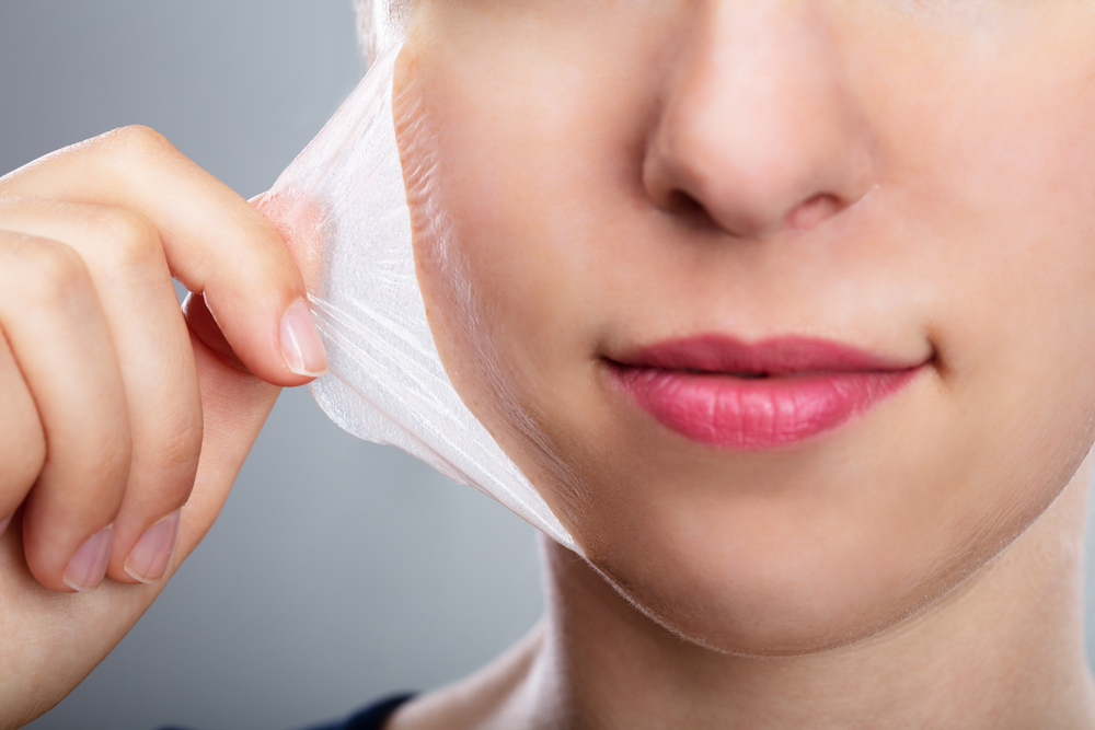 Professional Grade Chemical Peel
